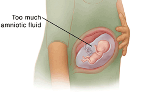Ảnh hưởng của chứng nhiều nước ối khi mang thai