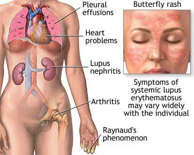 Lupus ban đỏ hệ thống và ảnh hưởng lên thai kỳ