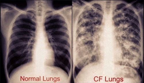 Bệnh xơ nang (cystic fibrosis - CF) ở trẻ em