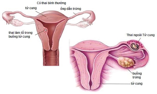 Nhận biết dấu hiệu mang thai ngoài tử cung