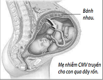 Nguy hiểm nhiễm cytomegalovirus khi mang thai