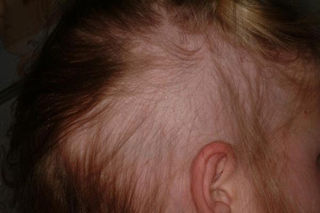 Rụng tóc ở trẻ em có đáng lo?