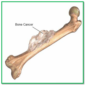Tìm hiểu về căn bệnh ung thư xương