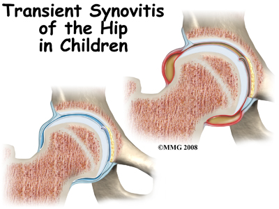 Tìm hiểu về bệnh viêm màng hoạt dịch khớp háng ở trẻ nhỏ