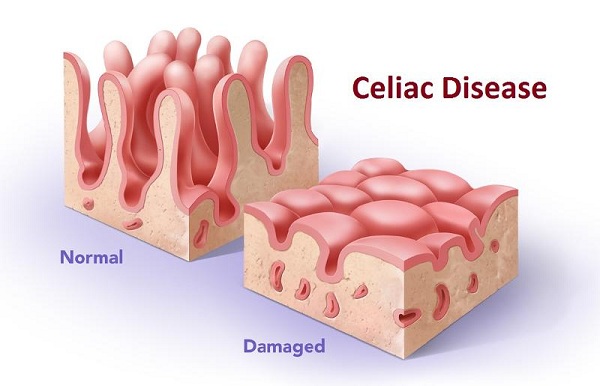 Chẩn đoán và điều trị bệnh celiac ở trẻ em