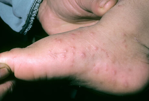 Các bệnh có biểu hiện triệu chứng da liễu thường gặp ở trẻ em