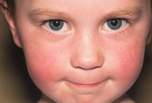 Các bệnh có biểu hiện triệu chứng da liễu thường gặp ở trẻ em