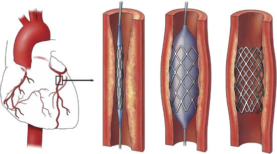 Những điều cần biết về đặt stent động mạch vành