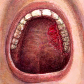 Các dấu hiệu ung thư khoang miệng