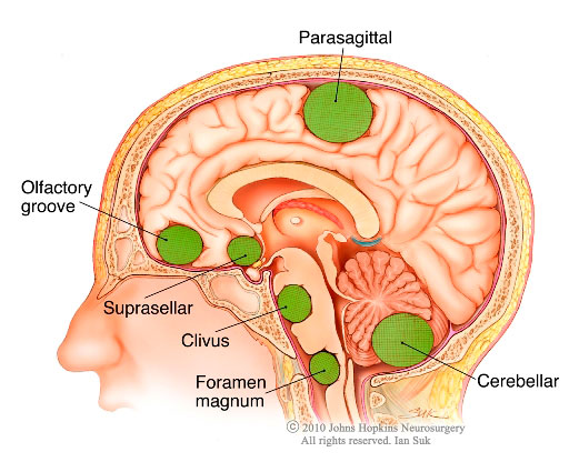 Kiểm soát và điều trị u màng não