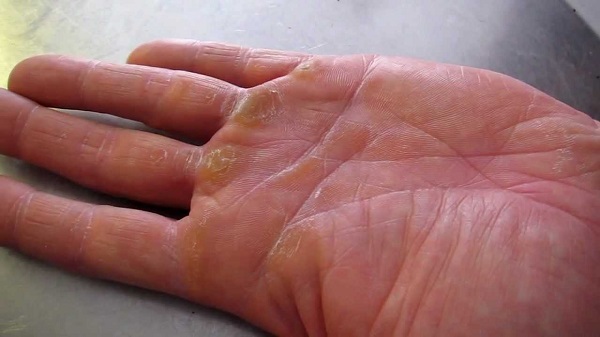 7 dấu hiệu cho thấy tay bạn cần được chăm sóc nhiều hơn