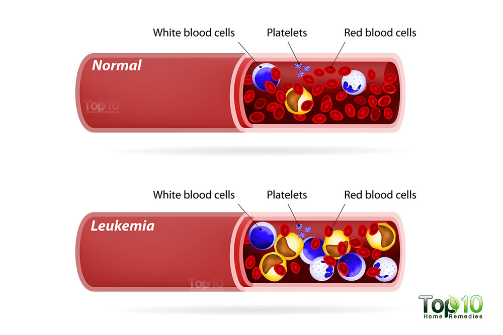 10 sự thật về bệnh ung thư máu