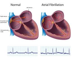 8 dấu hiệu thay đổi tim mạch trong thời kì mãn kinh