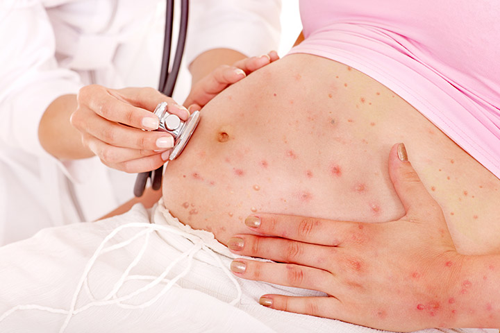 Sàng lọc virus varicella-zoster khi mang thai