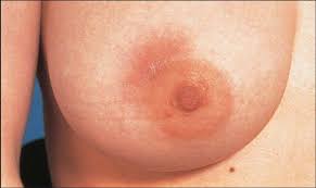 Những điều cần biết về bệnh viêm vú