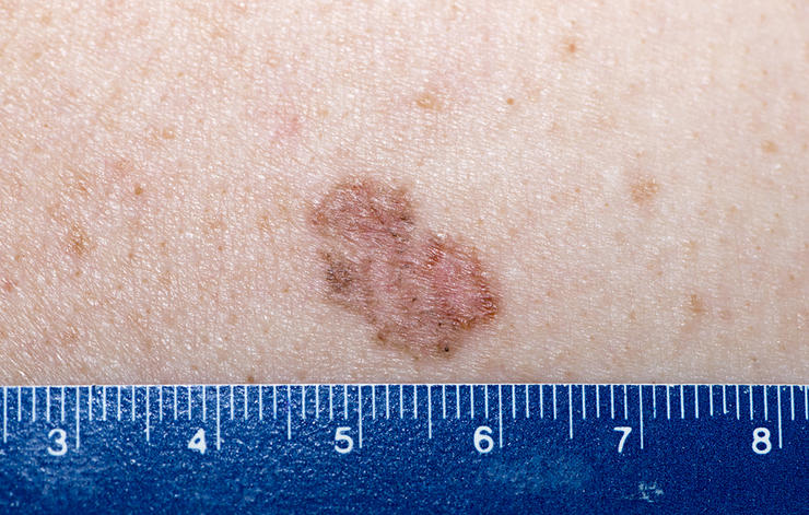 5 dấu hiệu bất ngờ của ung thư da