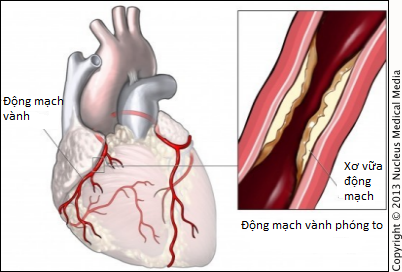 Bóc tách động mạch vành – bệnh tim nguy hiểm ở phụ nữ trẻ