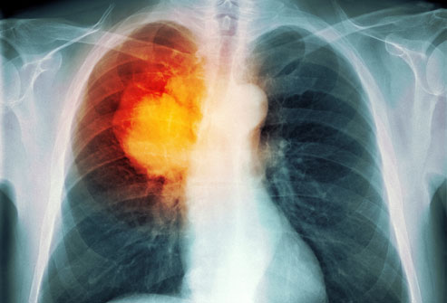 Toàn cảnh về bệnh ung thư phổi