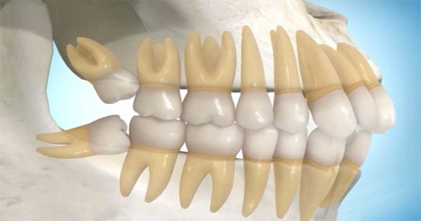 Biến chứng mọc răng khôn? Khi nào cần nhổ răng khôn? | VIAM
