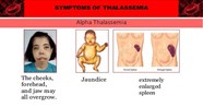 Thalassemia Nguy n Nh n Tri u Ch ng V i u Tr Ph n 2 VIAM