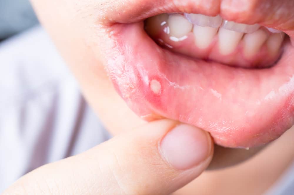 Loét miệng hoặc nứt nẻ ở khóe miệng | viamclinic.vn