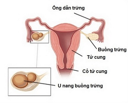 U nang buồng trứng và thai kỳ