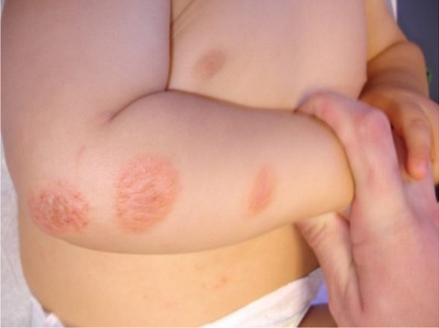 Hăm da trẻ em - Phòng và điều trị an toàn cho bé