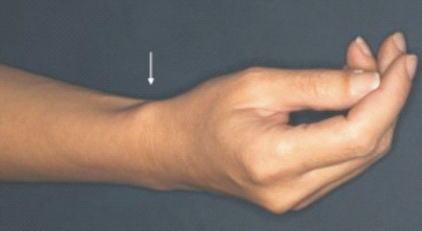 Các bệnh lý vùng cổ bàn tay do lạm dụng thiết bị thông minh