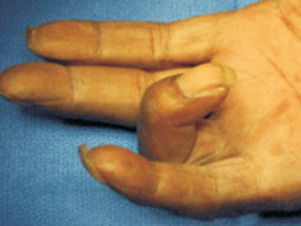 Các bệnh lý vùng cổ bàn tay do lạm dụng thiết bị thông minh