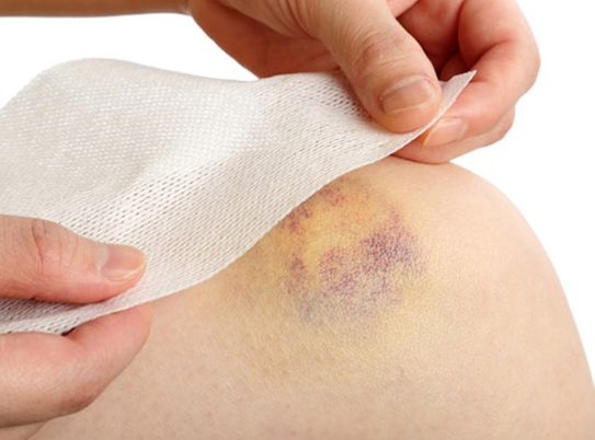 Cảnh giác bệnh nguy hiểm về máu khi có vết bầm trên da