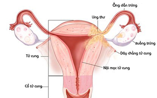 Vi-rút HPV: Nguy cơ hàng đầu gây ung thư cổ tử cung