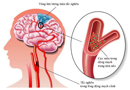 Cơn thiếu máu cục bộ não thoáng qua: Dấu hiệu cảnh báo đột quỵ
