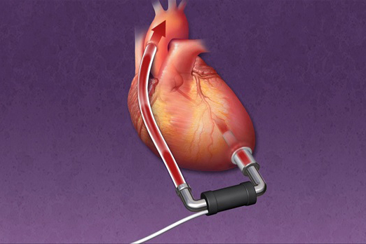 Thiết bị hỗ trợ suy tim có thể giúp người bệnh hồi phục hoàn toàn