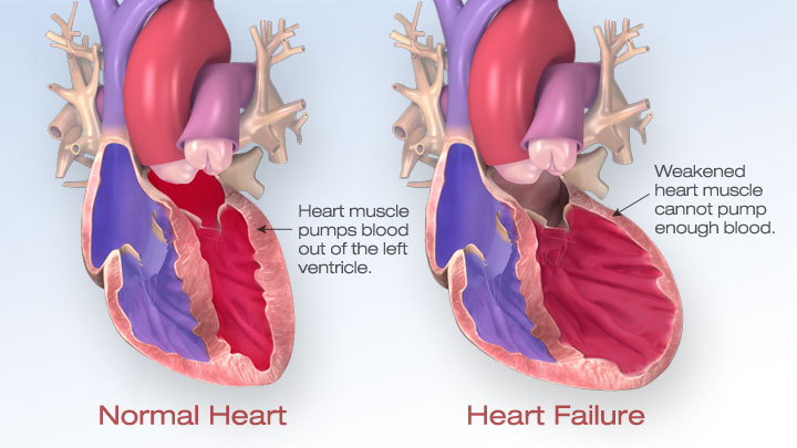 Suy tim: Những hiểu biết cơ bản, cách phát hiện, điều trị và dự phòng
