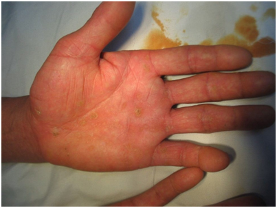 Một số biểu hiện ở da do nhiễm độc Arsenic