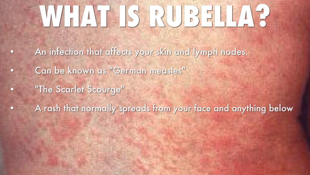 Chủ động tiêm vắc xin phòng tránh dịch rubella