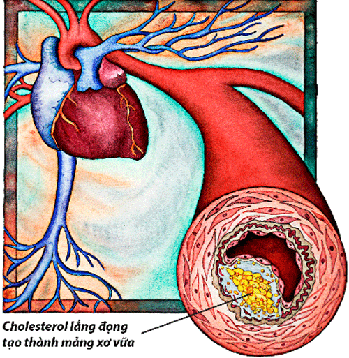 Mỡ máu và mối liên hệ đến bệnh tim mạch