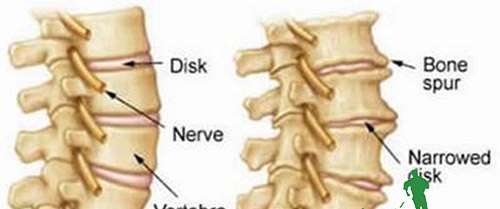 Nguyên nhân & cách điều trị thoái hóa cột sống thắt lưng