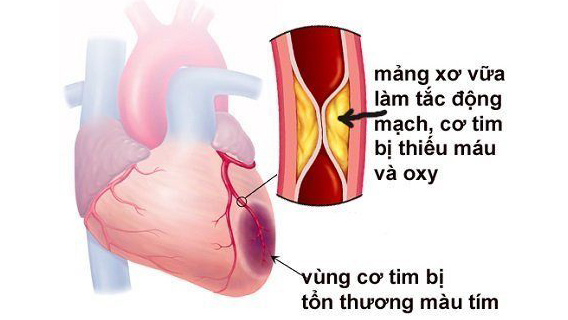Sự khác nhau giữa nhồi máu cơ tim và suy tim