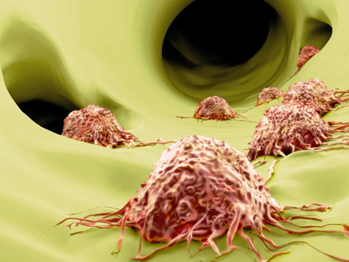 Tìm ra phương pháp mới có thể ngăn chặn khối u di căn