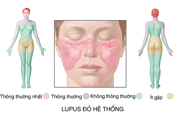 Bệnh lupus ban đỏ: Diễn biến chậm, dễ bị bỏ sót