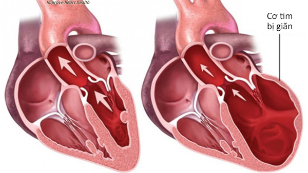 Các dấu hiệu "tố" bệnh tim bạn không nên bỏ qua