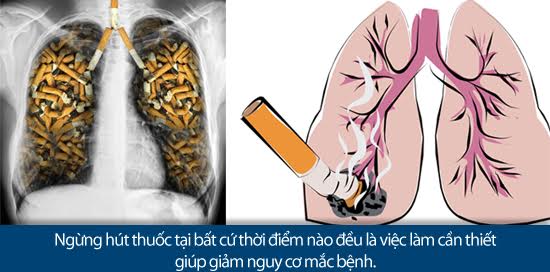 Ung thư phổi – Không phải dấu chấm hết!
