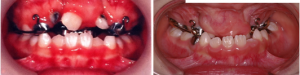Cách chăm sóc trẻ hở môi, vòm miệng từ lúc sơ sinh đến trưởng thành