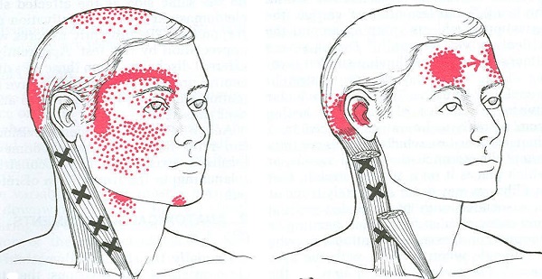 Nguyên nhân của các cơn đau đầu sau tai