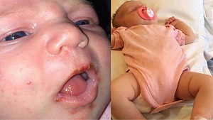 Bệnh herpes ở trẻ sơ sinh có thể nguy hiểm cho đời sống của trẻ không?
