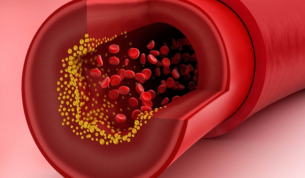 Tác hại của việc có mức VLDL cholesterol cao đối với sức khỏe?