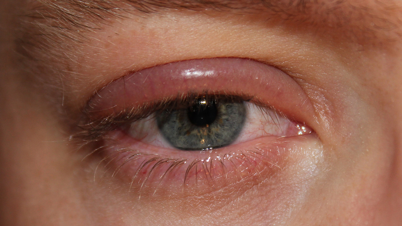 Làm thế nào để chăm sóc da xung quanh mắt khi bị đỏ?
