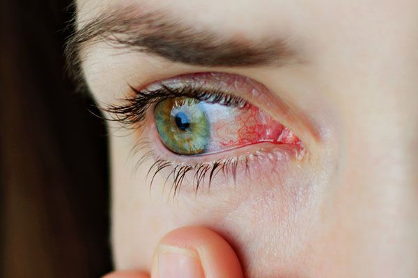 Sưng khóe mắt có nguy hiểm không?

