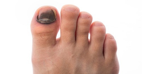 5 nguyên nhân dẫn đến móng chân đen – và khi nào nên đến khám bác sĩ | VIAM